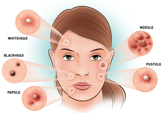 have-acne-prone-skin-here-are-some-things-you-should-avoid-doing-have