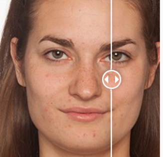 Proactiv before and after